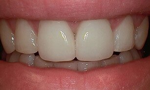 corrected chipped tooth
