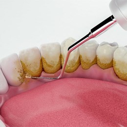Illustration of dental tool removing built-up plaque